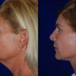 side profile of woman's face after Neck Lift showing tighter skin and contours