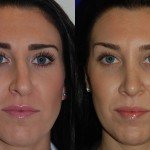 rhinoplasty before and after