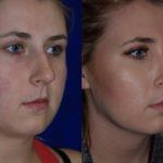Before and after woman's Rhinoplasty to improve nose shape