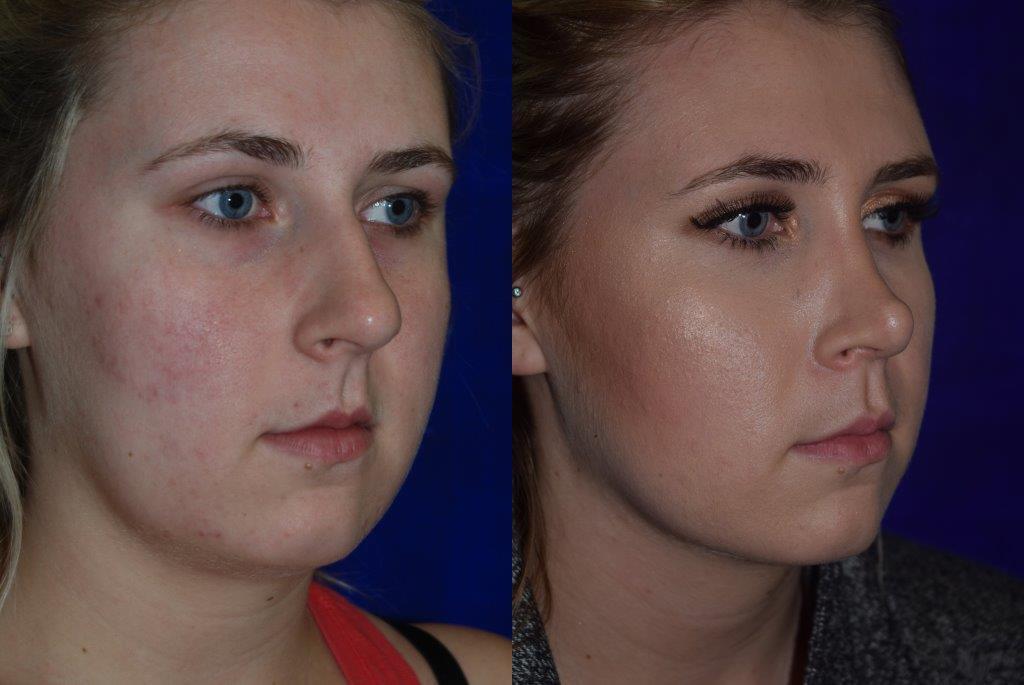 free plastic surgery nose