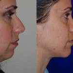 rhinoplasty before and after