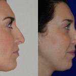 rhinoplasty before and after