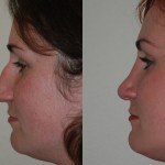 rhinoplasty before and after