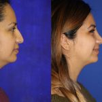 Before and after woman's laser resurfacing treatment for rhinoplasty (nose job)