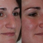 rhinoplasty before and after