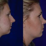 Before and after woman's Rhinoplasty to improve nose shape
