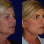 Facelift and Neck Lift before and after