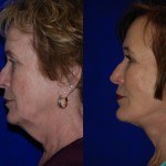 side profile of woman's face and neck before and after facelift and neck lift