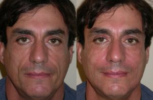 botox before and after