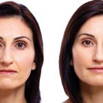 Liquid Facelift before and after