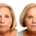 Liquid Facelift before and after