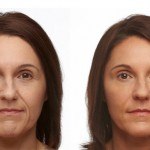 Liquid Facelift before and after woman