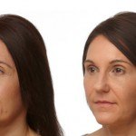 Liquid Facelift before and after