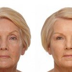 Liquid Facelift before and after Santa Rosa