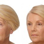 Liquid Facelift before and after