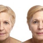Liquid Facelift before and after on woman