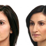 Liquid Facelift before and after woman