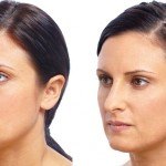 Liquid Facelift before and after