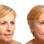 Liquid Facelift before and after