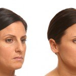 Liquid Facelift before and after