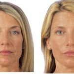 Liquid Facelift before and after Santa Rosa