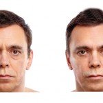 Liquid Facelift before and after