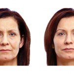 Liquid Facelift before and after