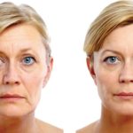 Liquid Facelift before and after