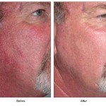 spider vein treatment before and after