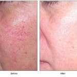 spider vein treatment before and after