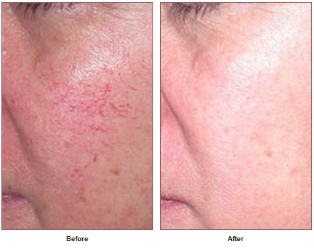 New Sex Images - Diminish facial spider veins facial spider veins Diminish