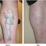 tattoo removal before and after