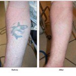 tattoo removal before and after