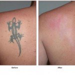 tattoo removal before and after