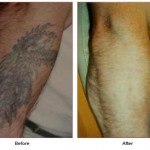 tattoo removal before and after