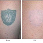 tattoo removal before and after