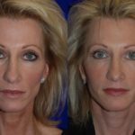 juvederm before and after