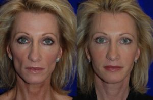 juvederm before and after