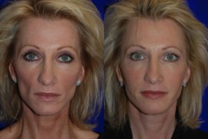 juvederm before and after