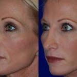 juvederm before and after