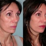 Sculptra before and after woman