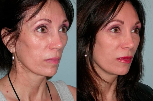 Sculptra before and after woman