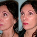 Sculptra before and after