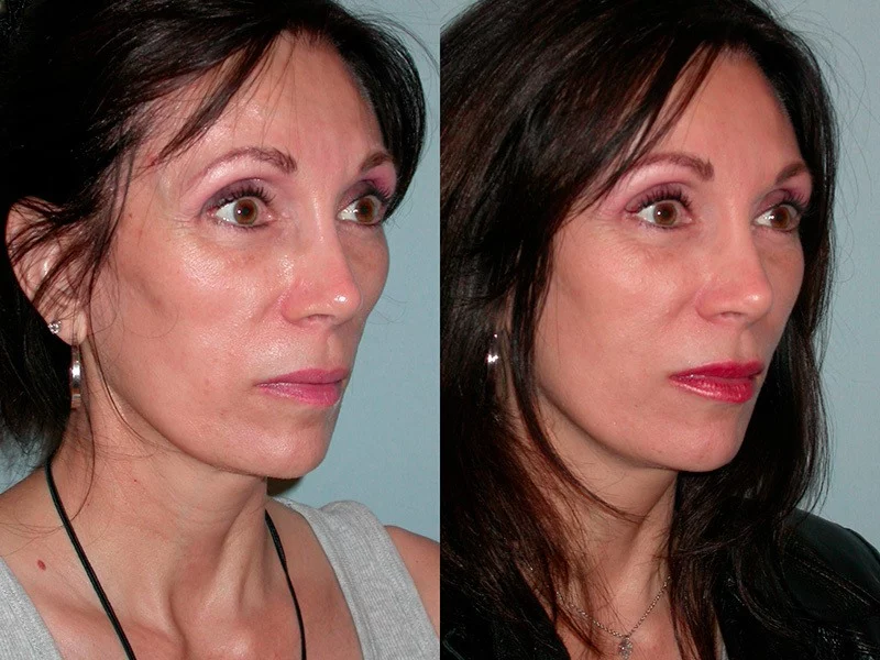 Sculptra before and after woman