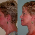 Chin Implants before and after