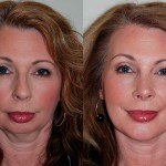 Chin Implants before and after