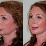 Chin Implants before and after