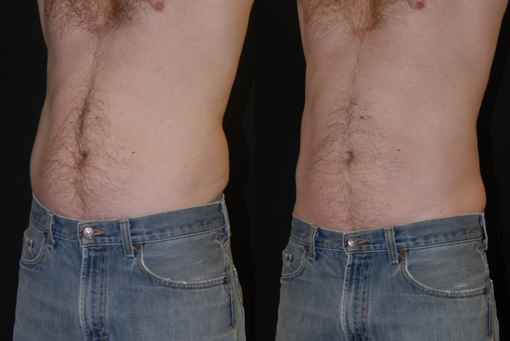 coolsculpting for abdomen before and after