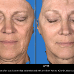 Juvederm Voluma before and after