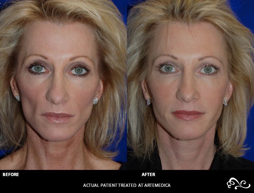 Juvederm Voluma before and after